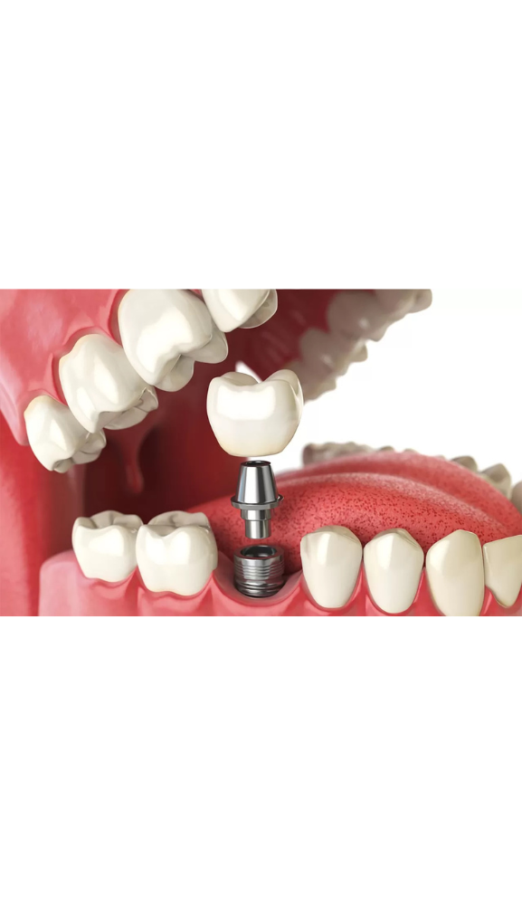 Implante em paranavai